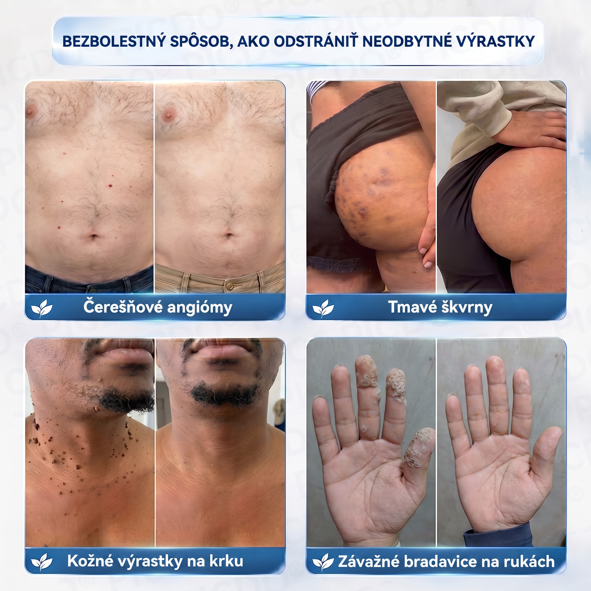 👨‍⚕️🌼Picdo® 7-dňový krém na odstránenie kožných výrastkov (receptúra bez bolesti a jaziev)