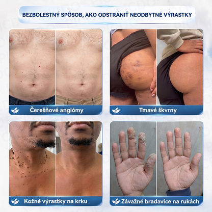 👨‍⚕️🌼Picdo® 7-dňový krém na odstránenie kožných výrastkov (receptúra bez bolesti a jaziev)