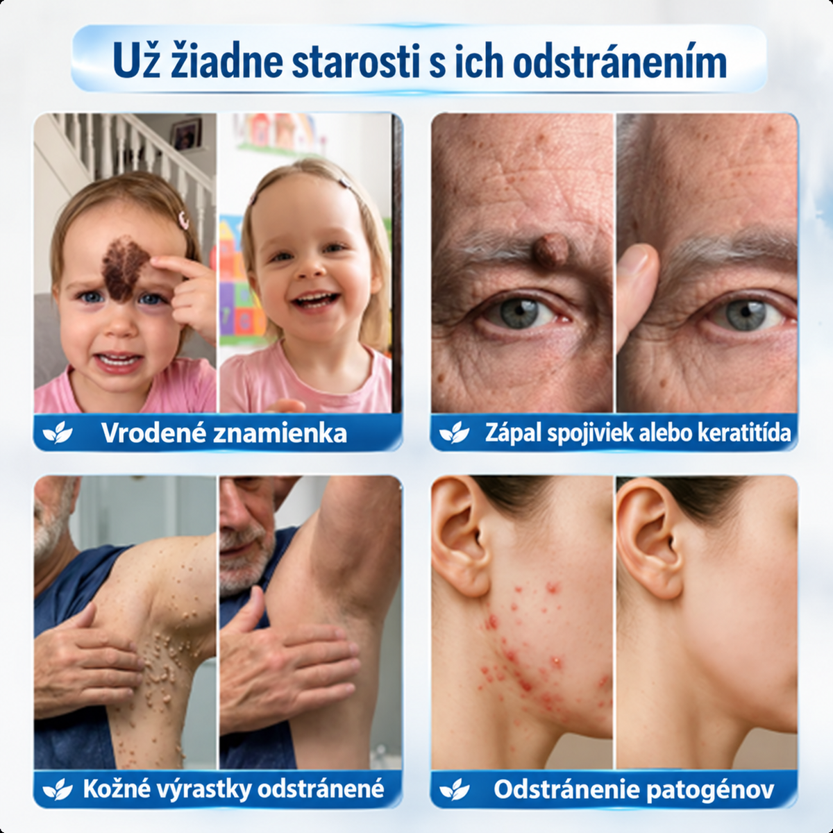 👨‍⚕️🌼Picdo® 7-dňový krém na odstránenie kožných výrastkov (receptúra bez bolesti a jaziev)