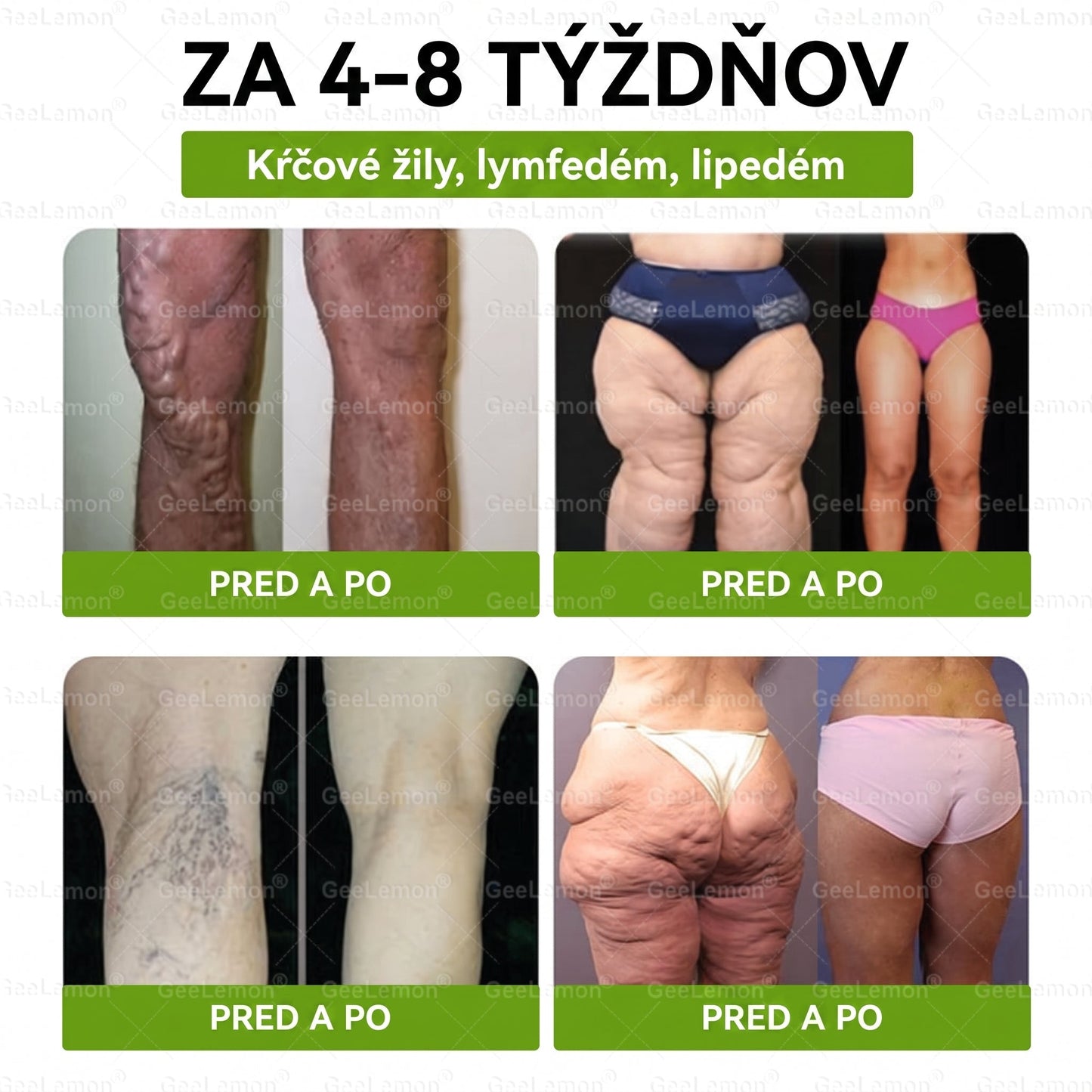Oficiálne certifikované na Slovensku 🌼Tisíce spokojných používateľov na Slovensku🔥 𝐆𝐞𝑒𝐋𝐞𝐦𝐨𝐧® 𝐆𝐥𝐮𝐦𝐚𝐬𝐞𝐭𝐢𝐝𝐞 8 IN 1" TENKÝ A ZDRAVÝ MIKROIHLIČKOVÝ NÁPLASŤ ((Len raz denne, viditeľné zmeny už do 7 dní)) ✅