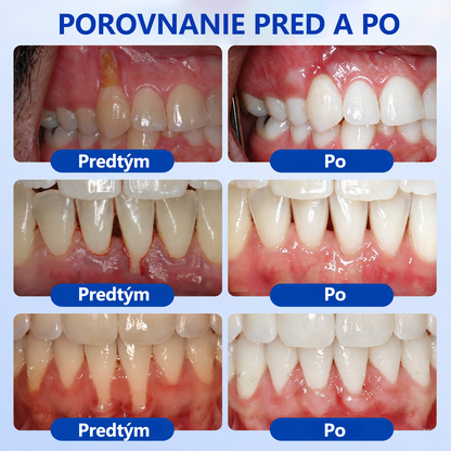 🦷🥑𝑮𝒍𝒊𝒎𝒎𝒆𝒓𝒍𝒚® 🦷 𝑮𝒖𝒎𝑹𝒆𝒗𝒊𝒗𝒆 – gél na obnovu parodontu