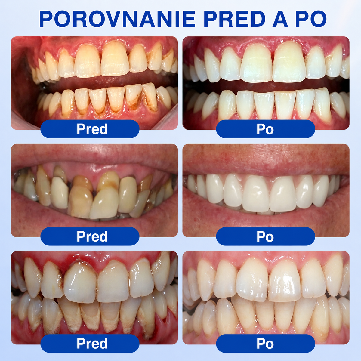 HEATWOLF® 👨‍⚕️🦷GumRevive Parodontálny opravný gél🍅