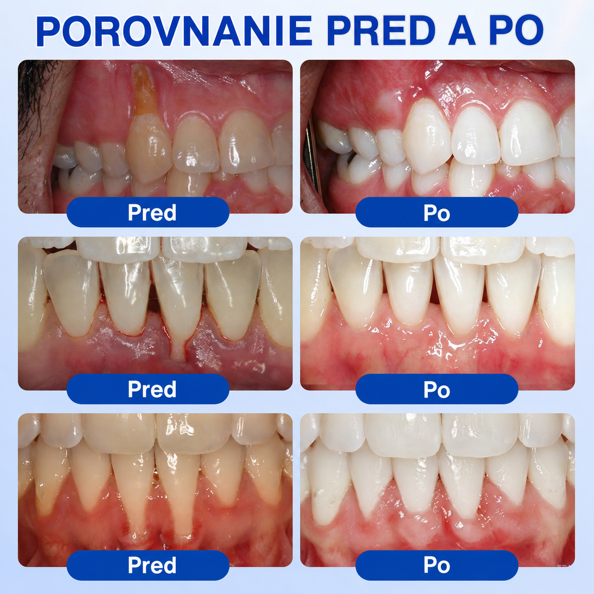 HEATWOLF® 👨‍⚕️🦷GumRevive Parodontálny opravný gél🍅