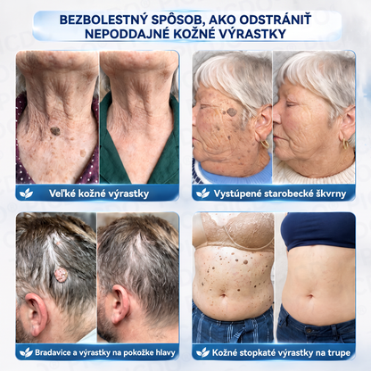 👨‍⚕️🌼Picdo® 7-dňový krém na odstránenie kožných výrastkov (receptúra bez bolesti a jaziev)